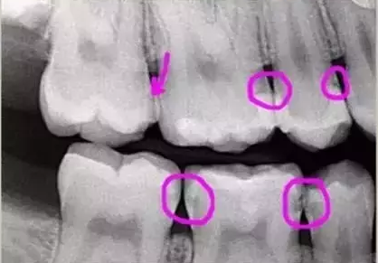 看牙齒為什么要拍片？